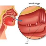 Top-Rated Nasal Polyps Surgeons for Advanced Care and Relief