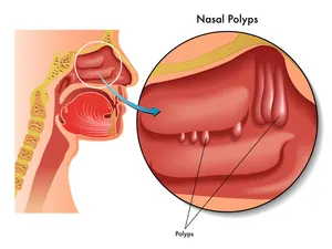 Top-Rated Nasal Polyps Surgeons for Advanced Care and Relief