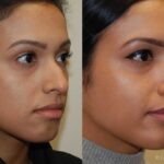 Discover the Best Rhinoplasty Options for Your Facial Enhancement