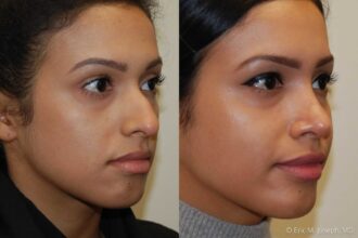 Discover the Best Rhinoplasty Options for Your Facial Enhancement